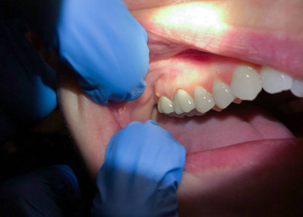 Best Broken or Chipped Tooth Repair in Woodside, CA